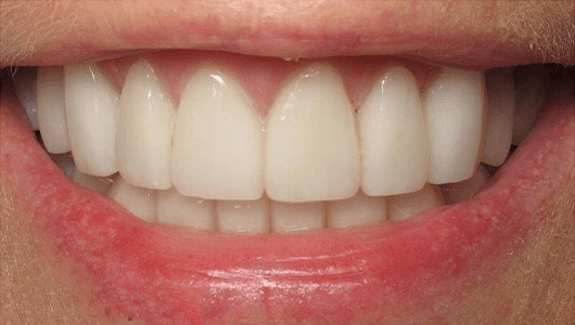 after dental work