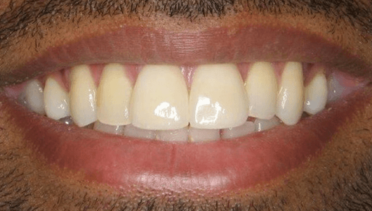 after dental work