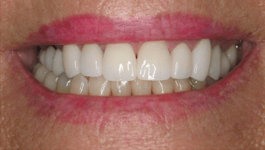 after dental work