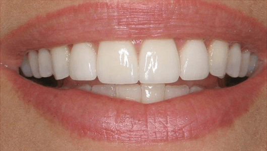 after dental work