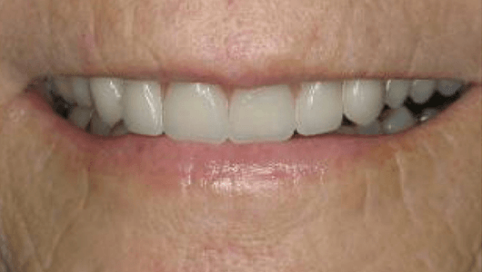 after dental work