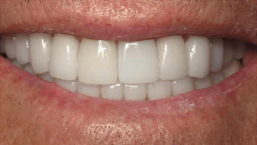 after dental work