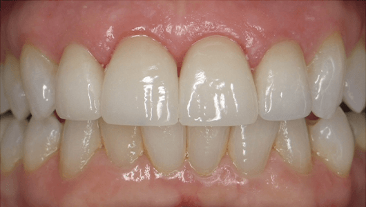 after dental work