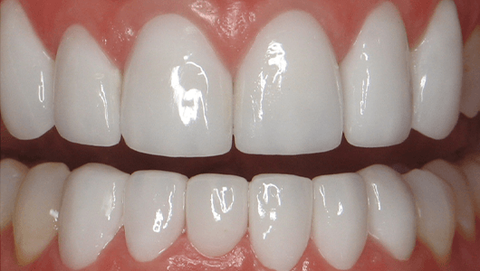 after dental work