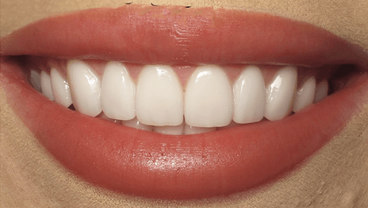 after dental work