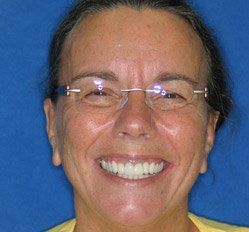 Close up of woman in Juno Beach showing imperfect teeth