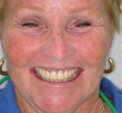 person in Juno Beach showing off smile makeover