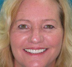 Close up of woman in Juno Beach showing imperfect teeth