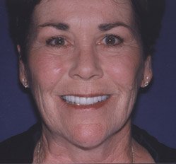 Close up of woman in Juno Beach showing imperfect teeth