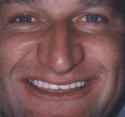 Close up of woman in Juno Beach showing imperfect teeth