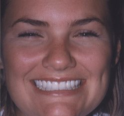 Close up of woman in Juno Beach showing imperfect teeth