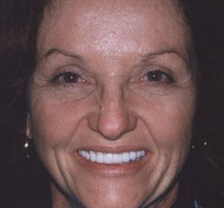 Close up of woman in Juno Beach showing imperfect teeth