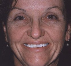 person in Juno Beach showing off smile makeover