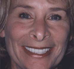 Close up of woman in Juno Beach showing imperfect teeth