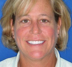 Close up Juno Beach woman's smile before dentistry