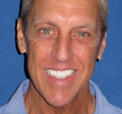 Close up of woman in Juno Beach showing imperfect teeth