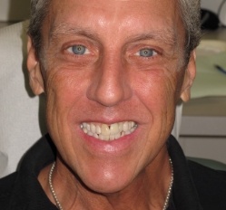 person in Juno Beach showing off smile makeover