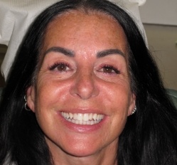 person in Juno Beach showing off smile makeover