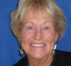 Close up of woman in Juno Beach showing imperfect teeth