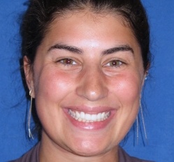 Close up of woman in Juno Beach showing imperfect teeth