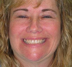 person in Juno Beach showing off smile makeover