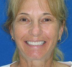 Close up of woman in Juno Beach showing imperfect teeth