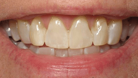 before dental work