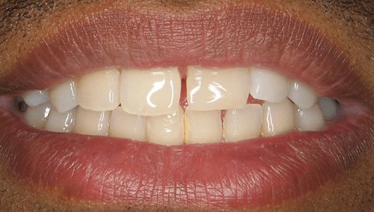 before dental work