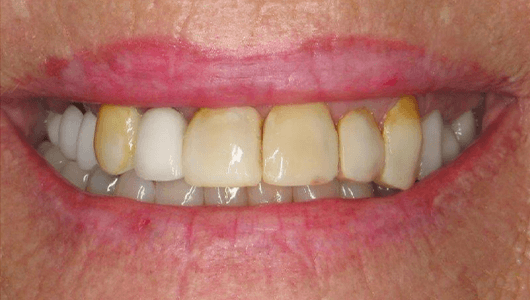 before dental work