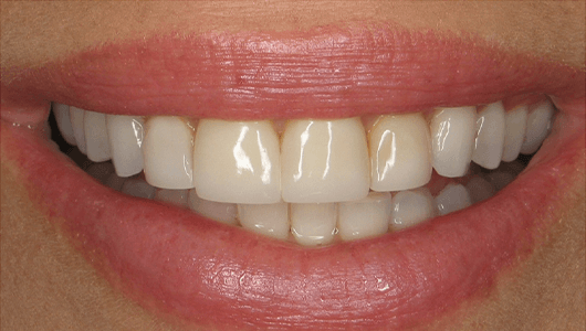 before dental work