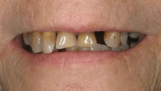 before dental work