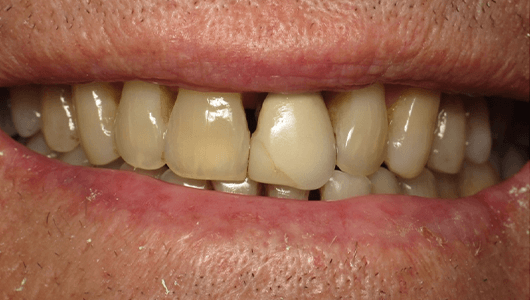 before dental work