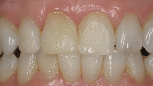 before dental work