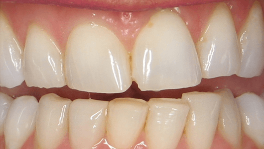 before dental work