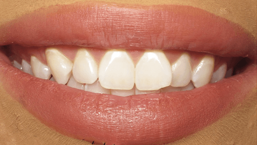 before dental work