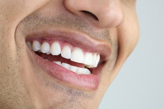 A man with veneers near The Bluffs in Jupiter