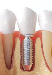 A model of a dental implant in a jaw in Cabana Colony