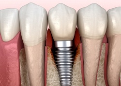 Illustration of peri-implantitis, a common cause of dental implant failure