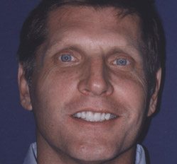 Ed after dental treatment
