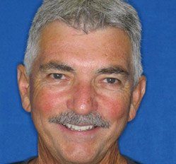 Jeff after dental treatment