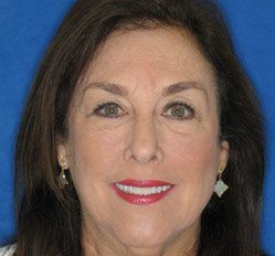 Real patient Linda after treatment