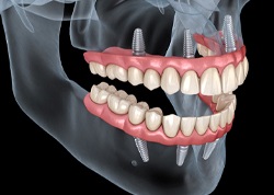 A digital image of a skull that contains implant dentures on the top and bottom rows in Juno Beach