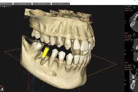 Results of CBCT scan, helping to plan for implant treatment