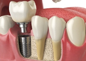 Illustration of single implant and restoration being placed in mouth