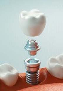 Illustration of a dental implant with a dental crown replacing a missing lower tooth