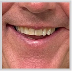 Close up of Juno Beach Man's mouth before smile makeover