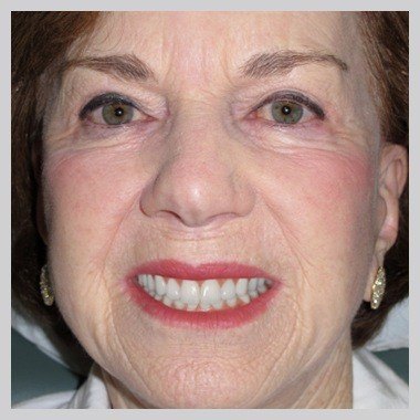 Juno Beach woman grinning after smile makeover