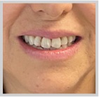 Close up of woman in Juno Beach showing imperfect teeth