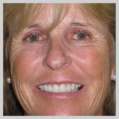 Juno Beach woman's beautiful smile after cosmetic dentistry