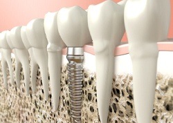 dental implant illustration